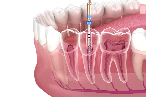 Désobturation endodontique : quand faut-il retraiter une dent déjà dévitalisée ?